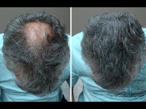 hair regrow treatment in india